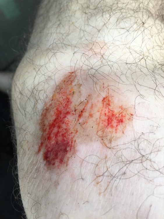 Banged-up knee on the Lollipop Track at Colquhoun Mountain Bike trail